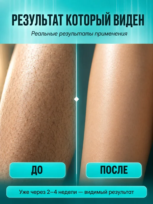 OPENWATCH Фотоэпилятор лазерный для лица и тела, вариант, фото 2